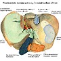 83. Powierzchnia trzewna wątroby - Visceral surface of liver