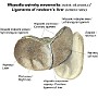 85. Więzadła wątroby noworodka (widok od przodu) - Ligaments of newborn's liver (anterior view)